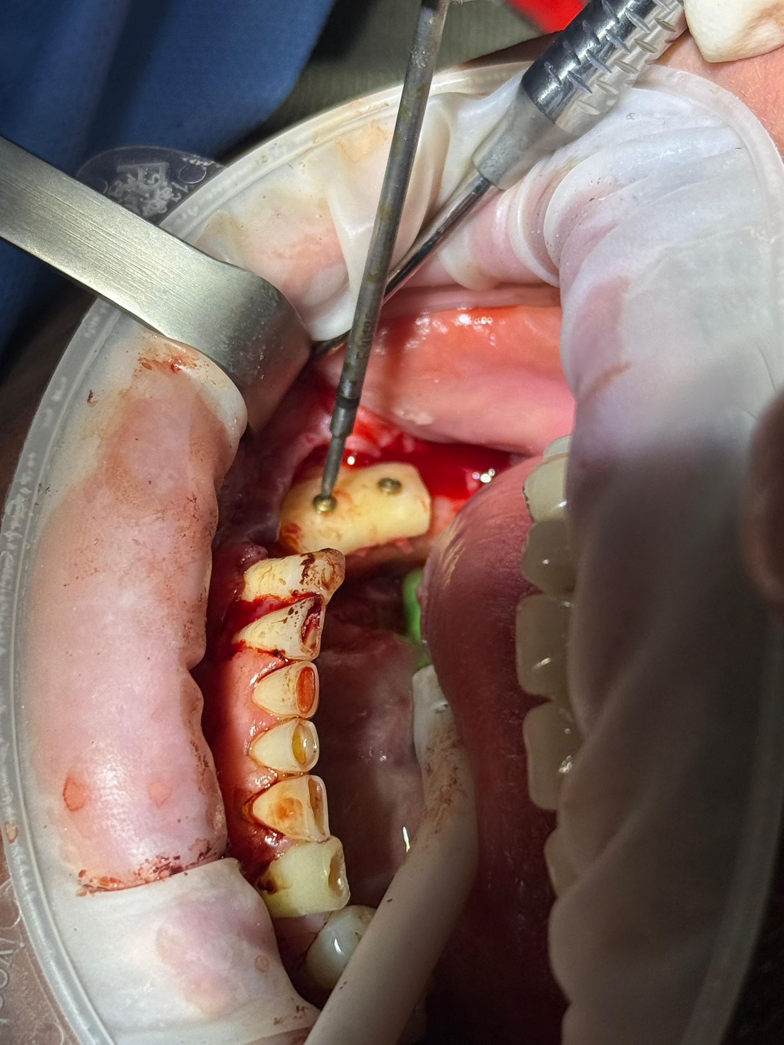 Procedură chirurgicală dentară