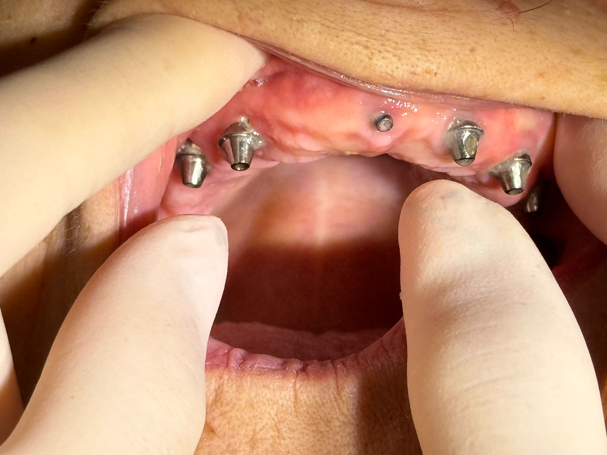 Tratament chirurgical dentar