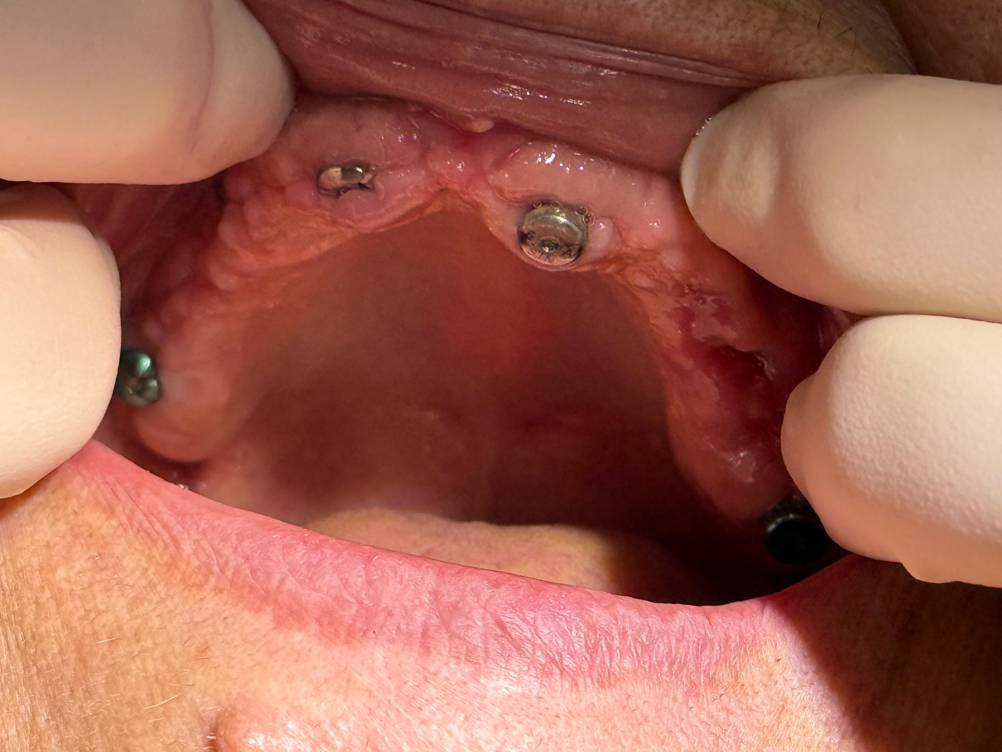 Chirurgie orală — procedură avansată