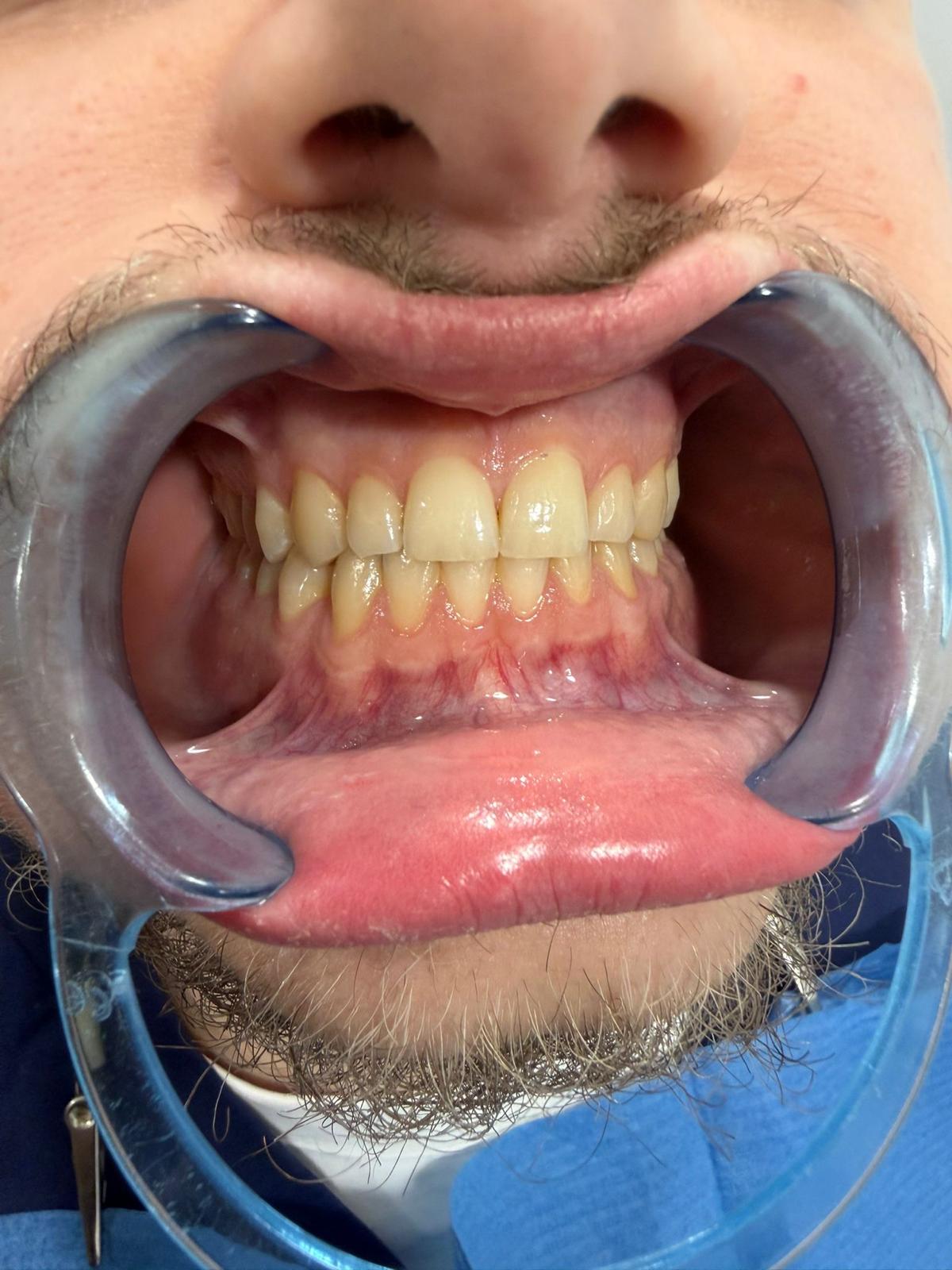 Filler buze — rezultat imediat