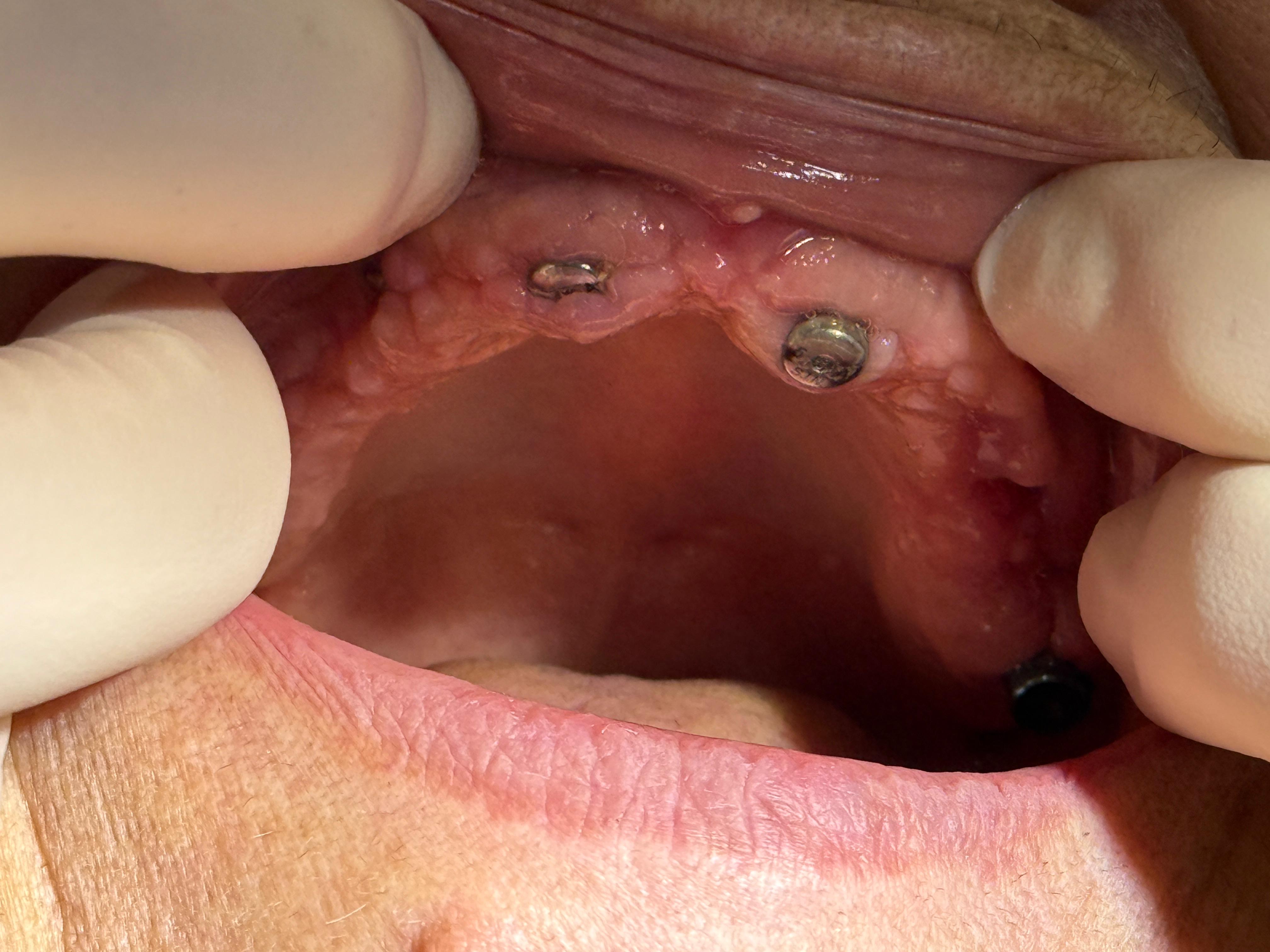 Implanturi dentare inferioare