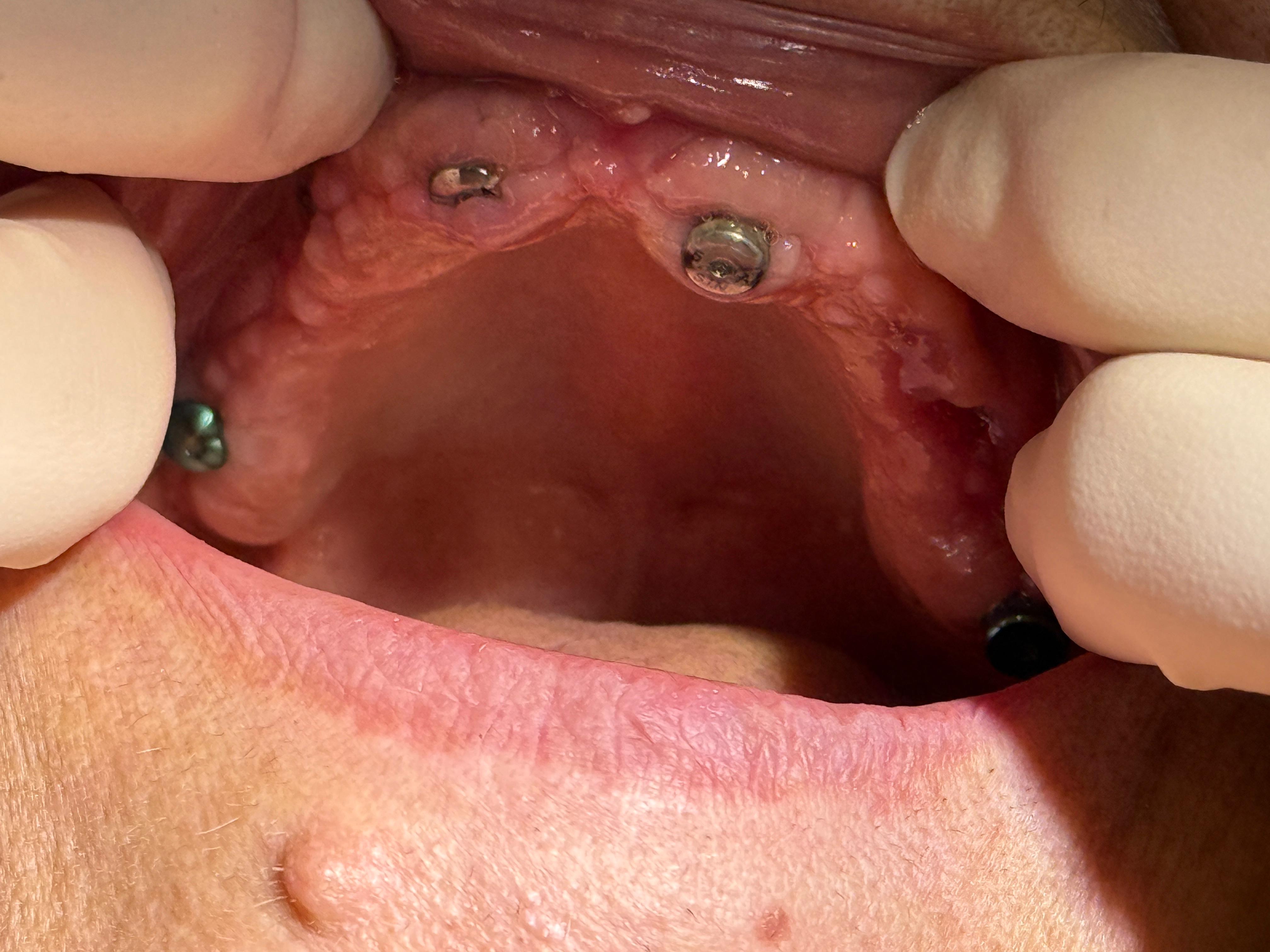 Implanturi dentare — faza de vindecare